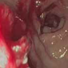 Initial bleed