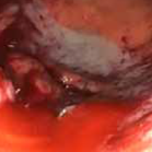 Initial bleed